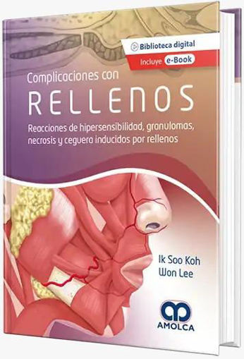 Imagen de Complicaciones con Rellenos. Reacciones de hipersensibilidad, granulomas, necrosis y ceguera inducid