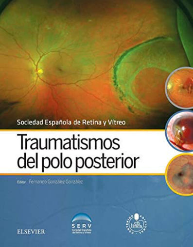 Imagen de Traumatismos del polo posterior