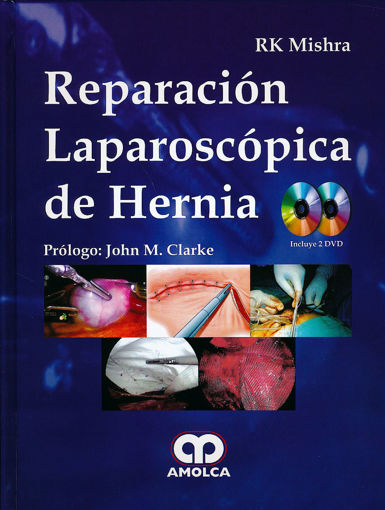 Imagen de Reparación Laparoscópica de Hernia