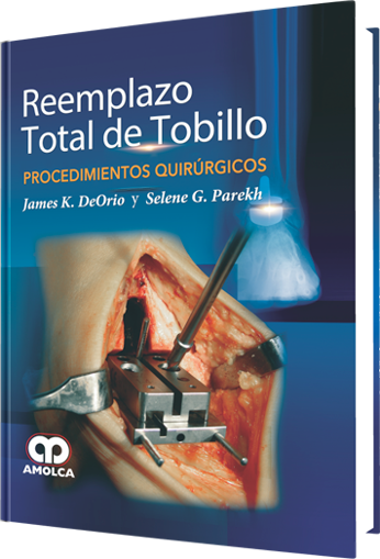 Imagen de Reemplazo total de tobillo Procedimientos quirúrgicos