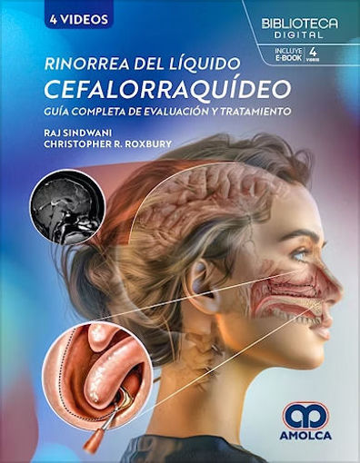 Imagen de Rinorrea del liquido cefalorraquideo. Guia completa de evaluacion y tratamiento