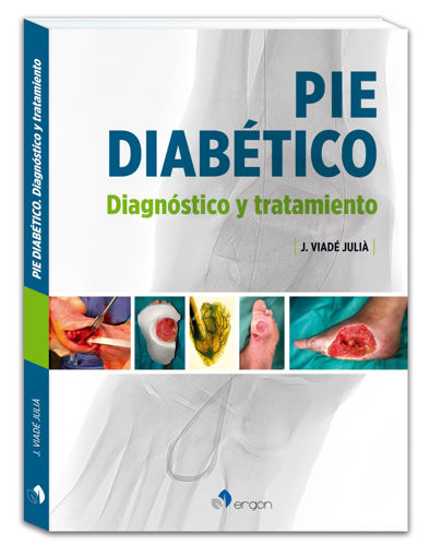 Imagen de Pie diabético Diagnóstico y tratamiento